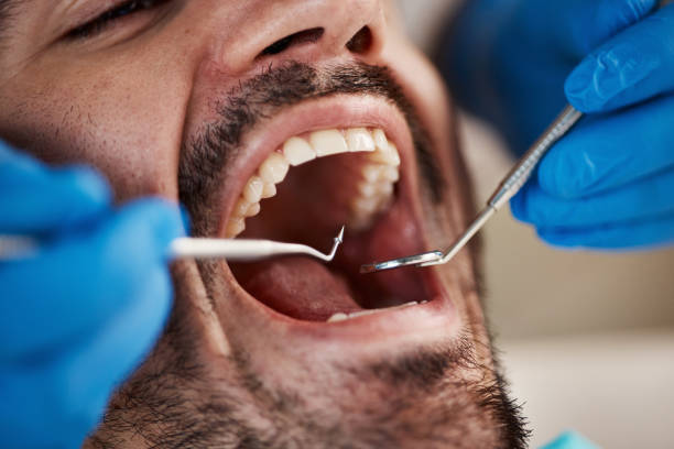 Best Emergency Wisdom Teeth Removal in Deephaven, MN